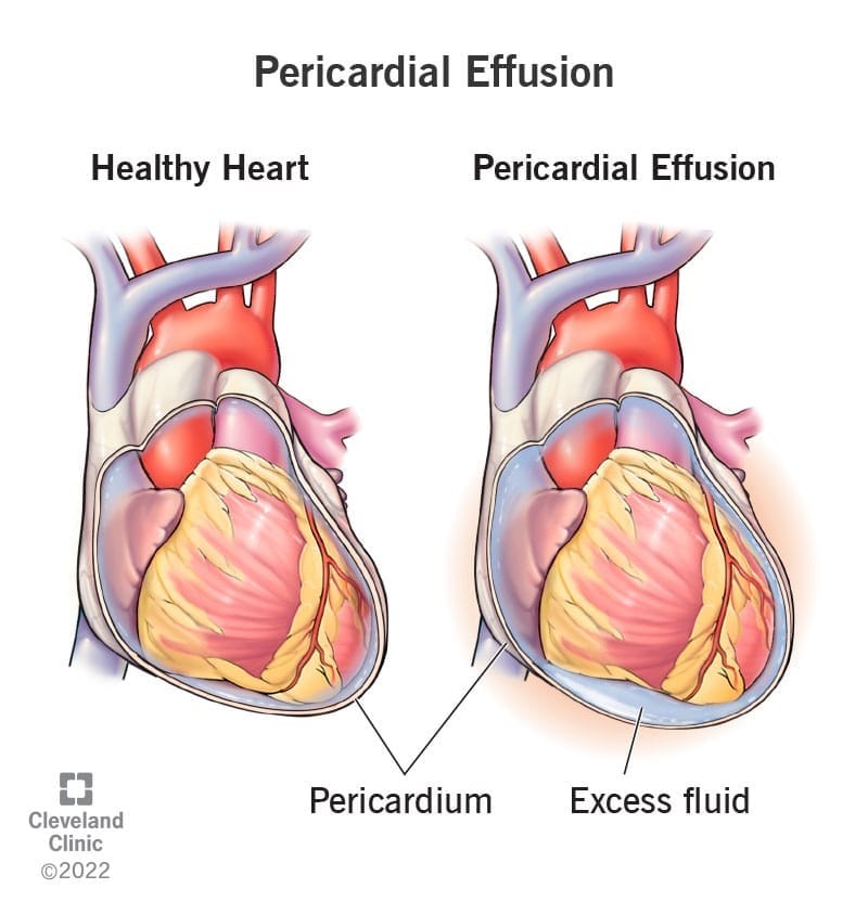 https://my.clevelandclinic.org/health/diseases/17351-pericardial-effusion